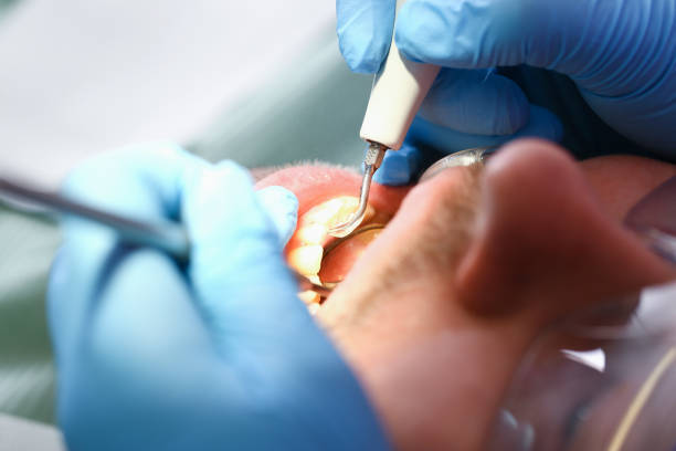 Best Chipped Tooth Repair Near Me  in Wellsburg, WV